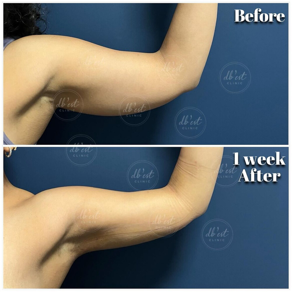 Before and After Result